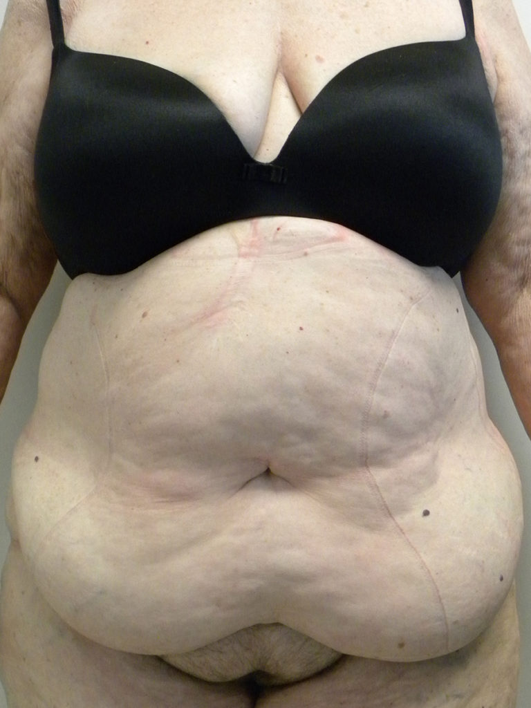 Tummy Tuck Before and After Pictures Miami, FL