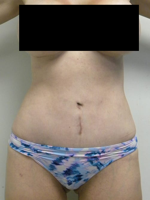 Tummy Tuck Before and After Pictures in Miami, FL