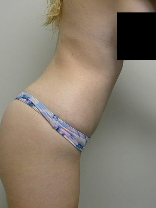 Tummy Tuck Before and After Pictures in Miami, FL