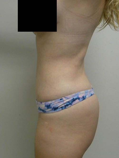 Tummy Tuck Before and After Pictures in Miami, FL