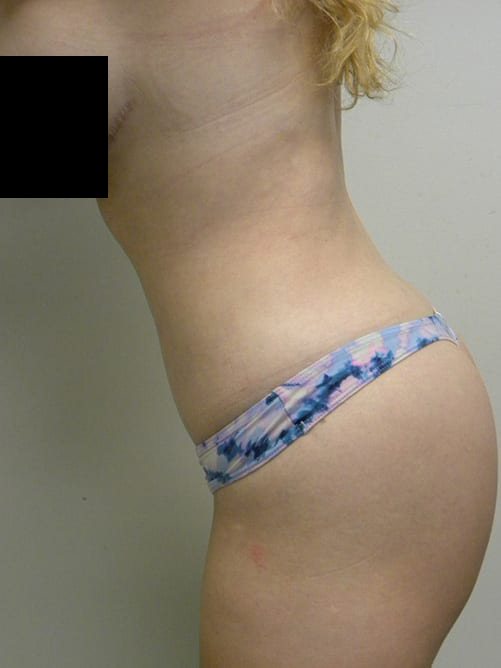 Tummy Tuck Before and After Pictures in Miami, FL