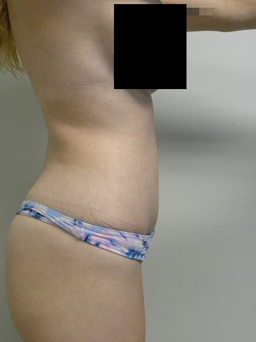 Tummy Tuck Before and After Pictures in Miami, FL