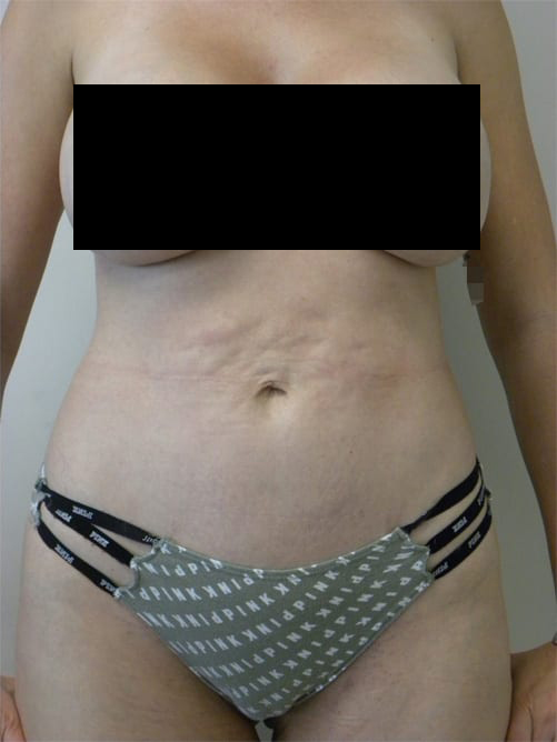 Tummy Tuck Before and After Pictures in Miami, FL