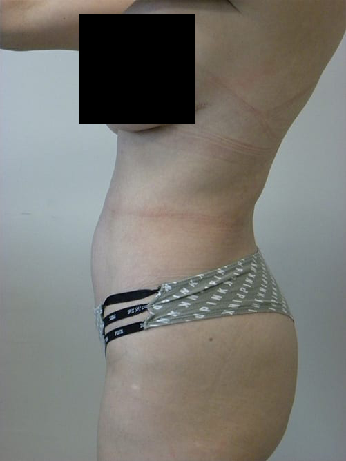 Tummy Tuck Before and After Pictures in Miami, FL