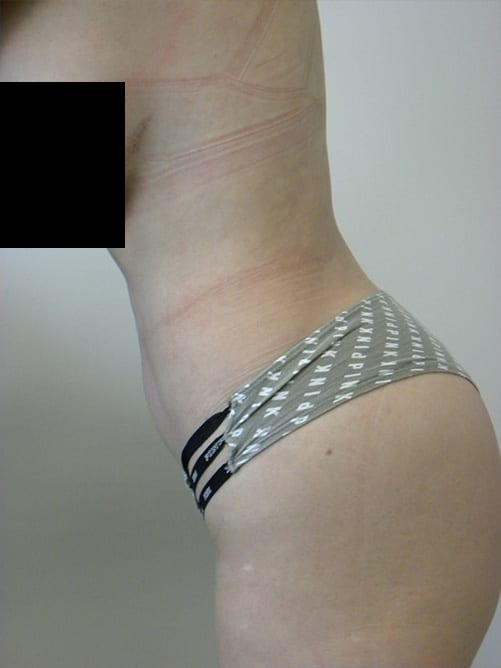 Tummy Tuck Before and After Pictures in Miami, FL