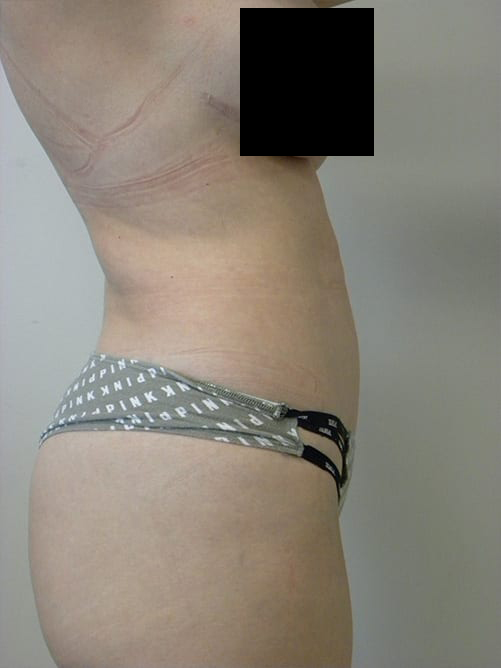 Tummy Tuck Before and After Pictures in Miami, FL