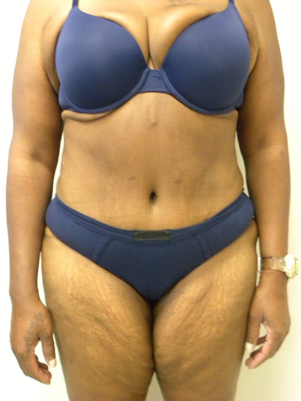 Tummy Tuck Before and After Pictures in Miami, FL