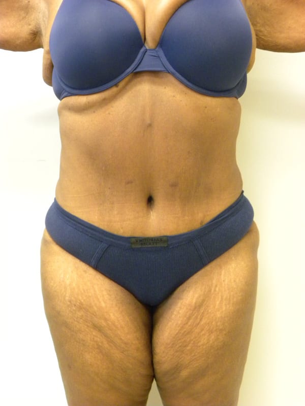 Tummy Tuck Before and After Pictures in Miami, FL