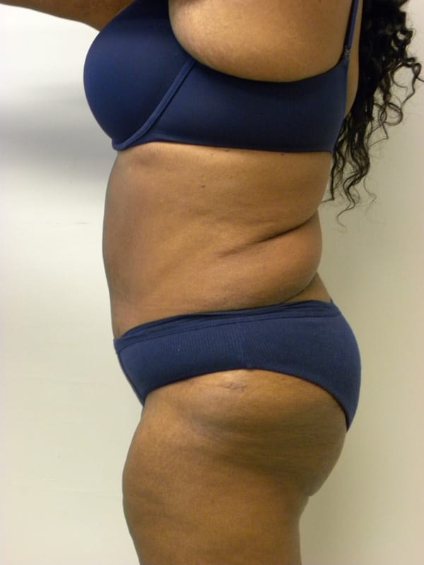 Tummy Tuck Before and After Pictures in Miami, FL