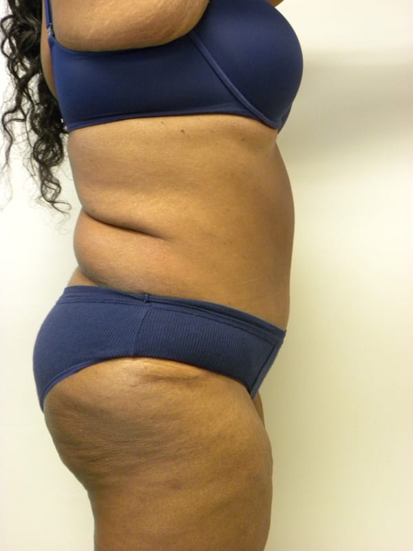 Tummy Tuck Before and After Pictures in Miami, FL