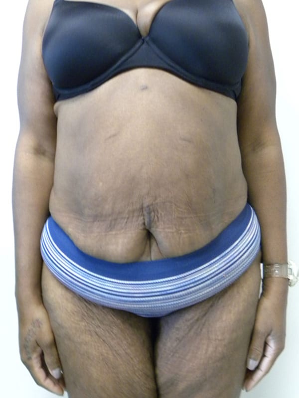 Tummy Tuck Before and After Pictures in Miami, FL