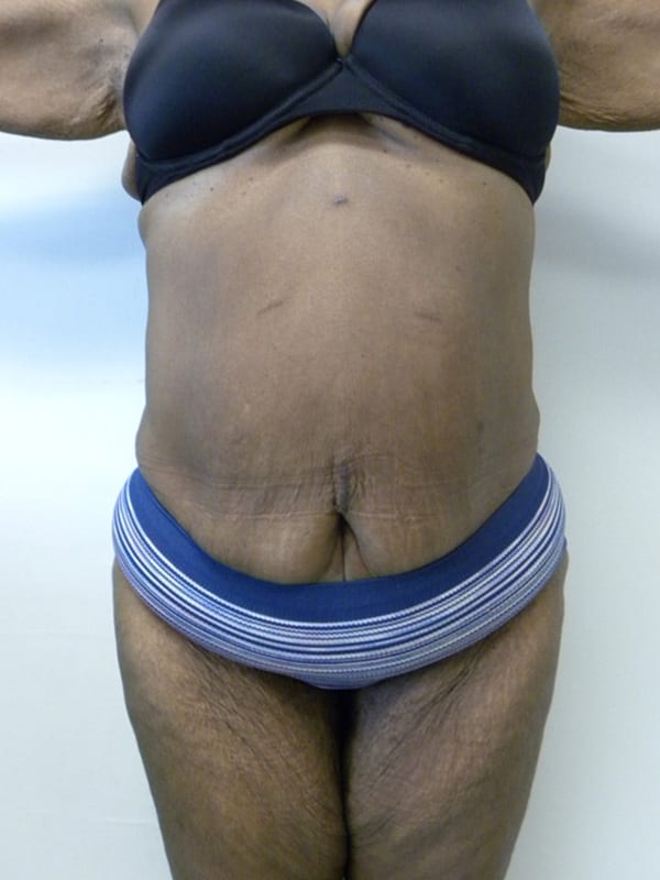 Tummy Tuck Before and After Pictures in Miami, FL