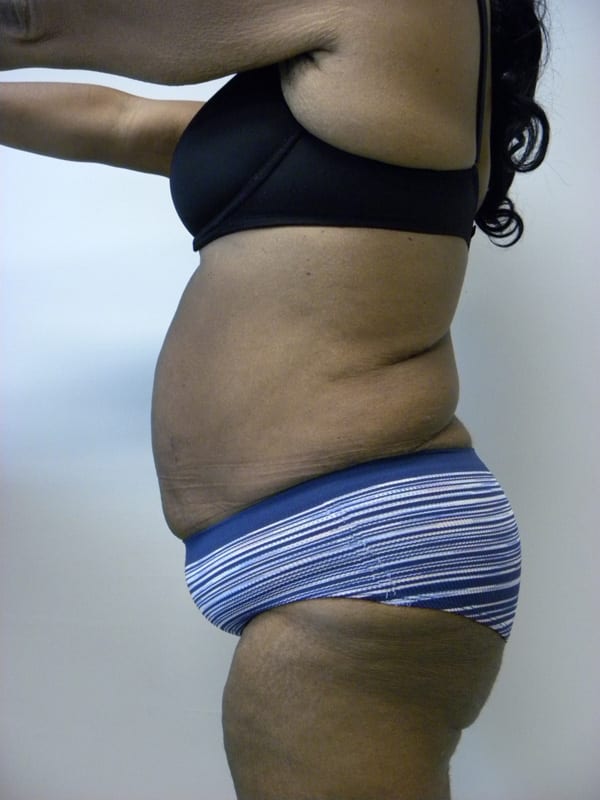 Tummy Tuck Before and After Pictures in Miami, FL