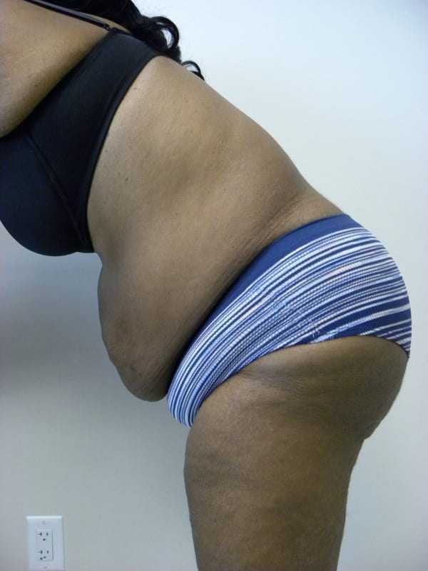 Tummy Tuck Before and After Pictures in Miami, FL