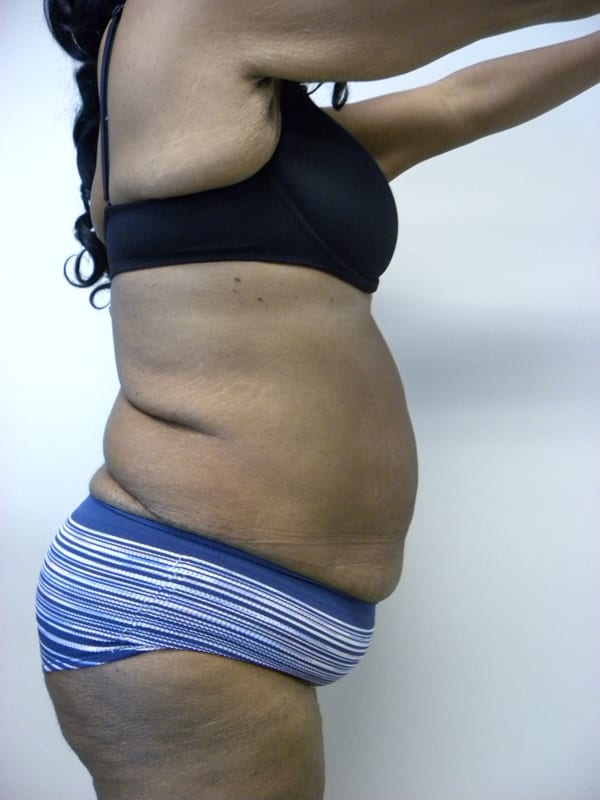 Tummy Tuck Before and After Pictures in Miami, FL