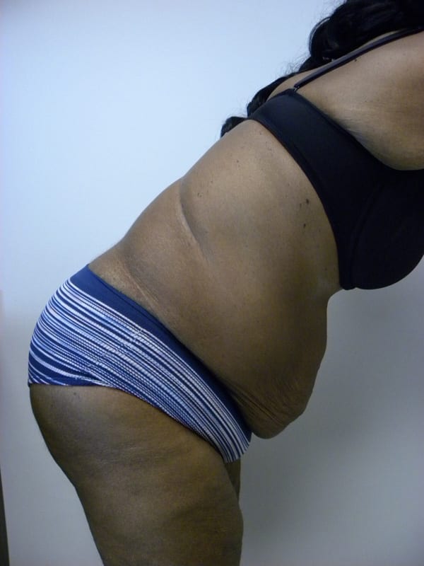 Tummy Tuck Before and After Pictures in Miami, FL